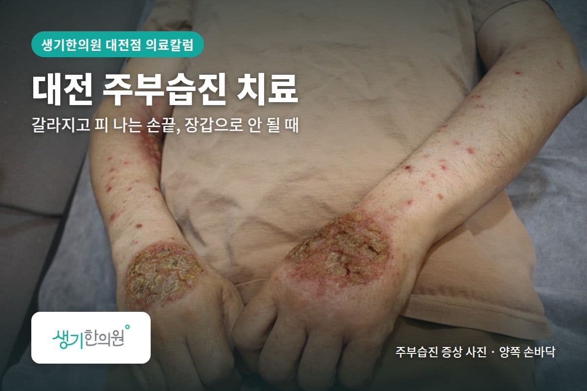 양쪽 손바닥 주부습진 증상 사진과 문구 「대전 주부습진 치료, 갈라지고 피 나는 손끝, 장갑으로 안 될 때 · 생기한의원 대전점」