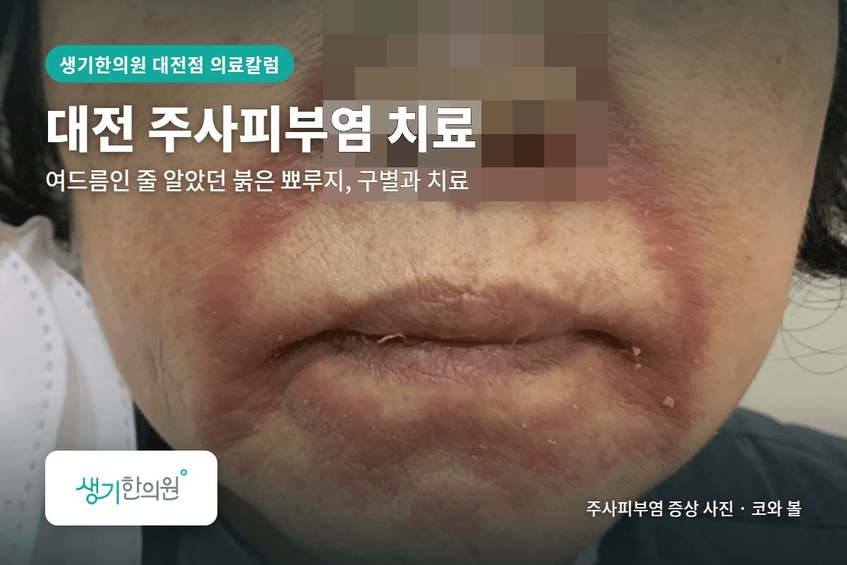 코와 볼 주사피부염 증상 사진과 문구 「대전 주사피부염 치료, 여드름인 줄 알았던 붉은 뽀루지, 구별과 치료 · 생기한의원 대전점」