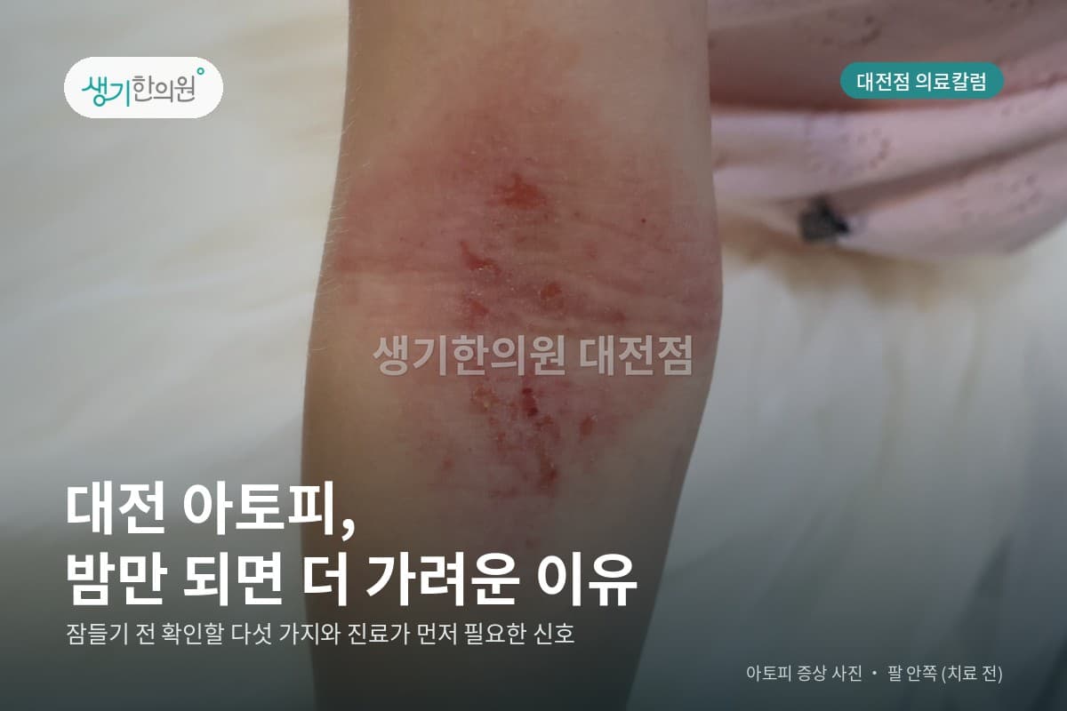 팔 안쪽 아토피 증상 사진과 문구 「대전 아토피, 밤만 되면 더 가려운 이유」 — 생기한의원 대전점 의료칼럼 표지 (치료 전)