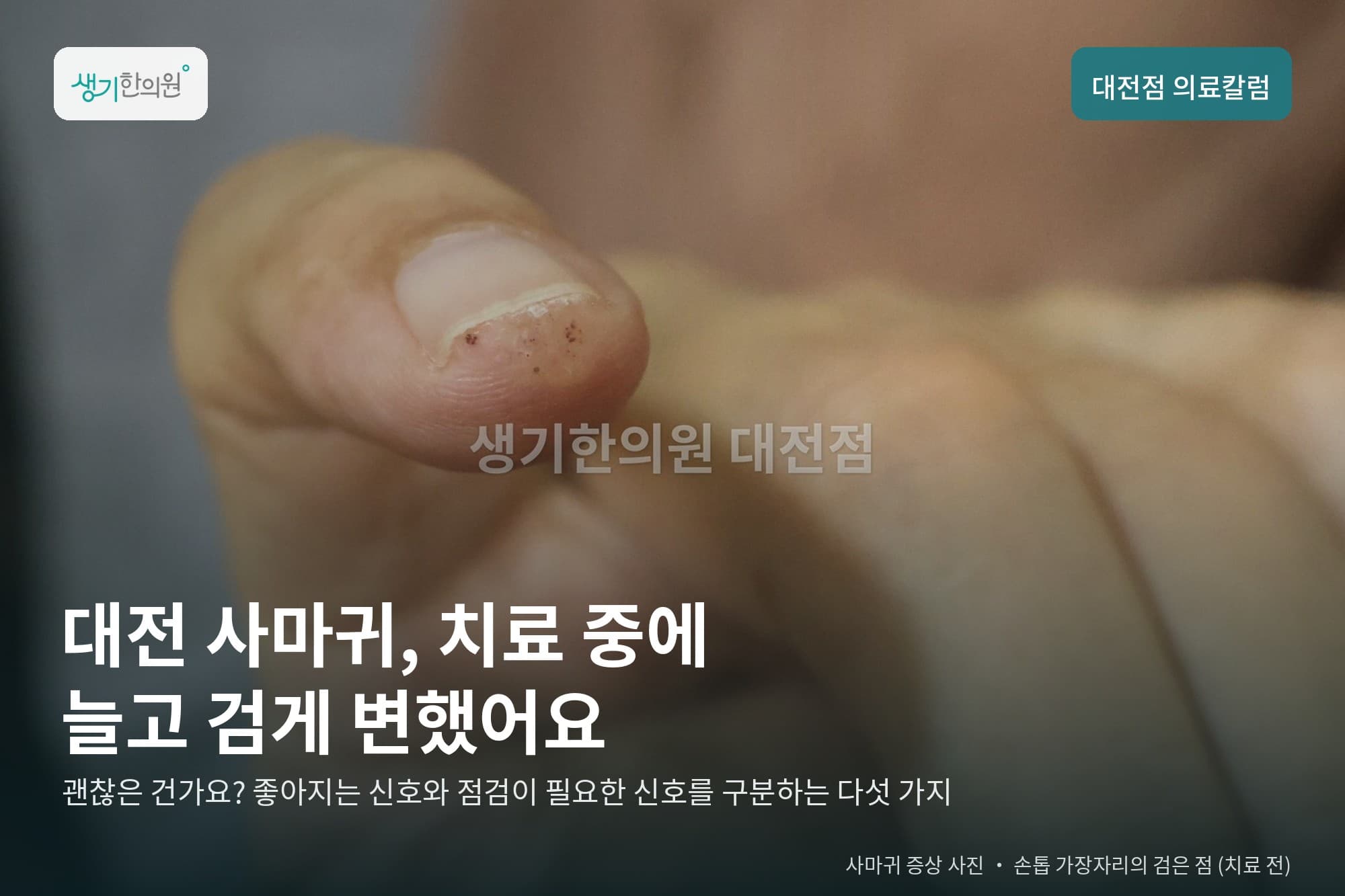 엄지 손톱 가장자리 사마귀 사진과 문구 「대전 사마귀, 치료 중에 늘고 검게 변했어요」 — 생기한의원 대전점 의료칼럼 표지 (치료 전)