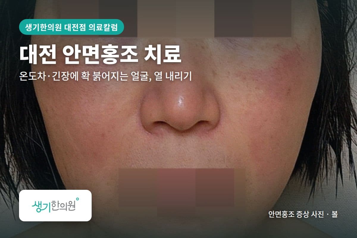 볼 안면홍조 증상 사진과 문구 「대전 안면홍조 치료, 온도차·긴장에 확 붉어지는 얼굴, 열 내리기 · 생기한의원 대전점」