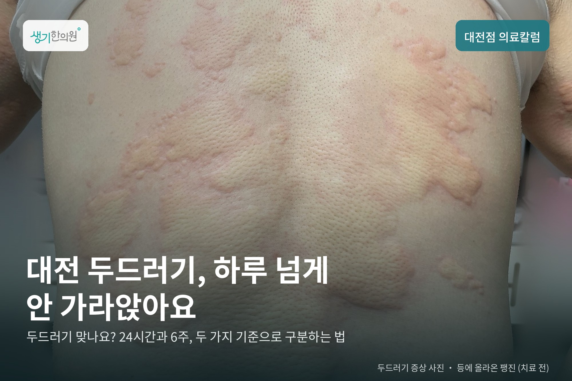 등에 넓게 올라온 두드러기 팽진 사진과 문구 「대전 두드러기, 하루 넘게 안 가라앉아요」 — 생기한의원 대전점 의료칼럼 표지 (치료 전)