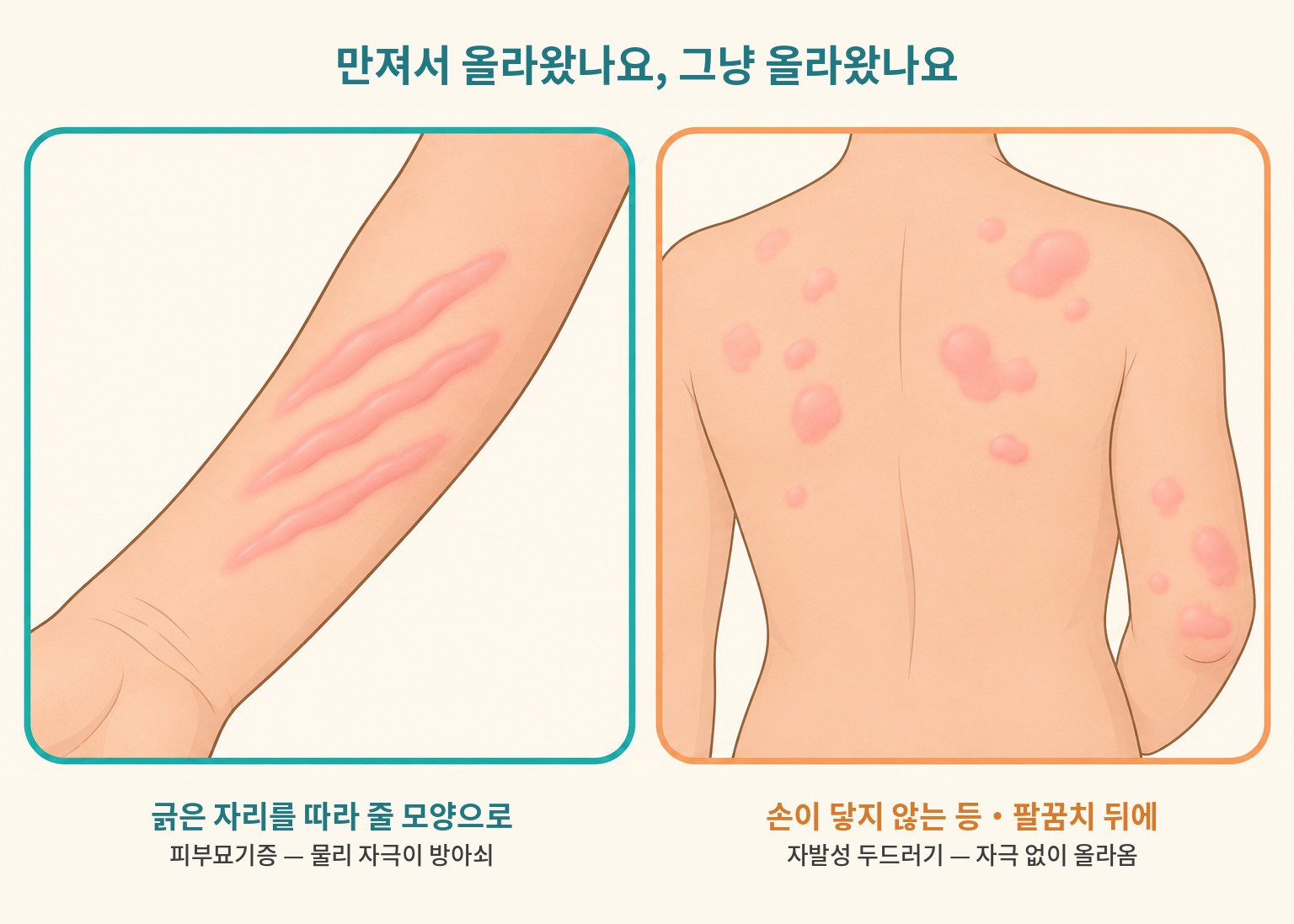 피부묘기증(긁은 자리를 따라 줄 모양)과 자발성 두드러기(등·팔꿈치 뒤에 자극 없이 올라옴)를 비교한 도해