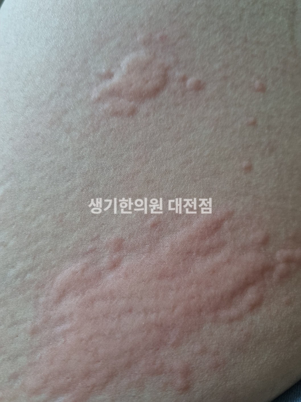 대전 두드러기 증상 사진 · 팔에 올라온 팽진 (치료 전)