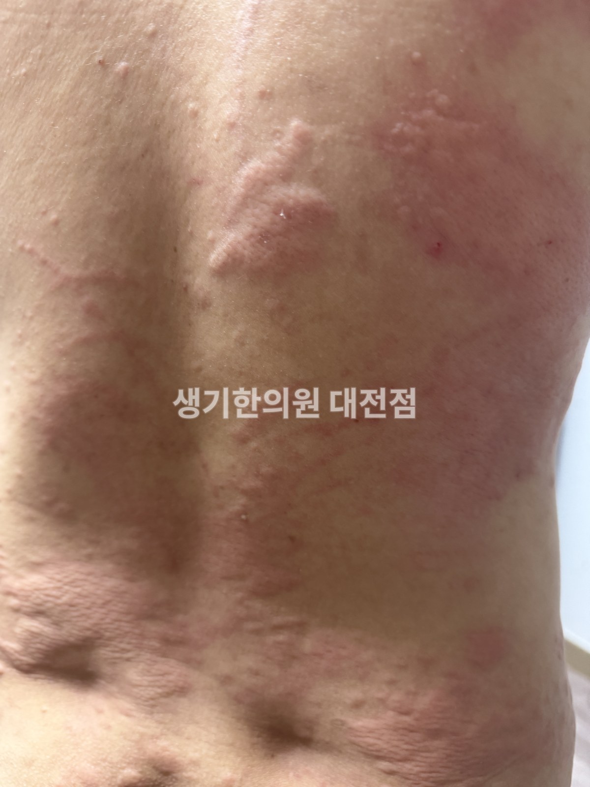대전 두드러기 증상 사진 · 등에 줄 모양으로 올라온 팽진 (치료 전)