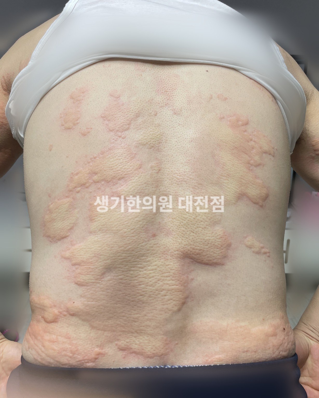 대전 두드러기 증상 사진 · 등 전체에 넓게 올라온 팽진 (치료 전, 배경 흐림 처리)