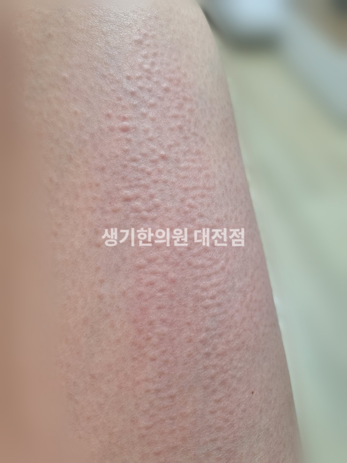 대전 두드러기 증상 사진 · 다리에 촘촘하게 올라온 팽진 (치료 전, 배경 흐림 처리)