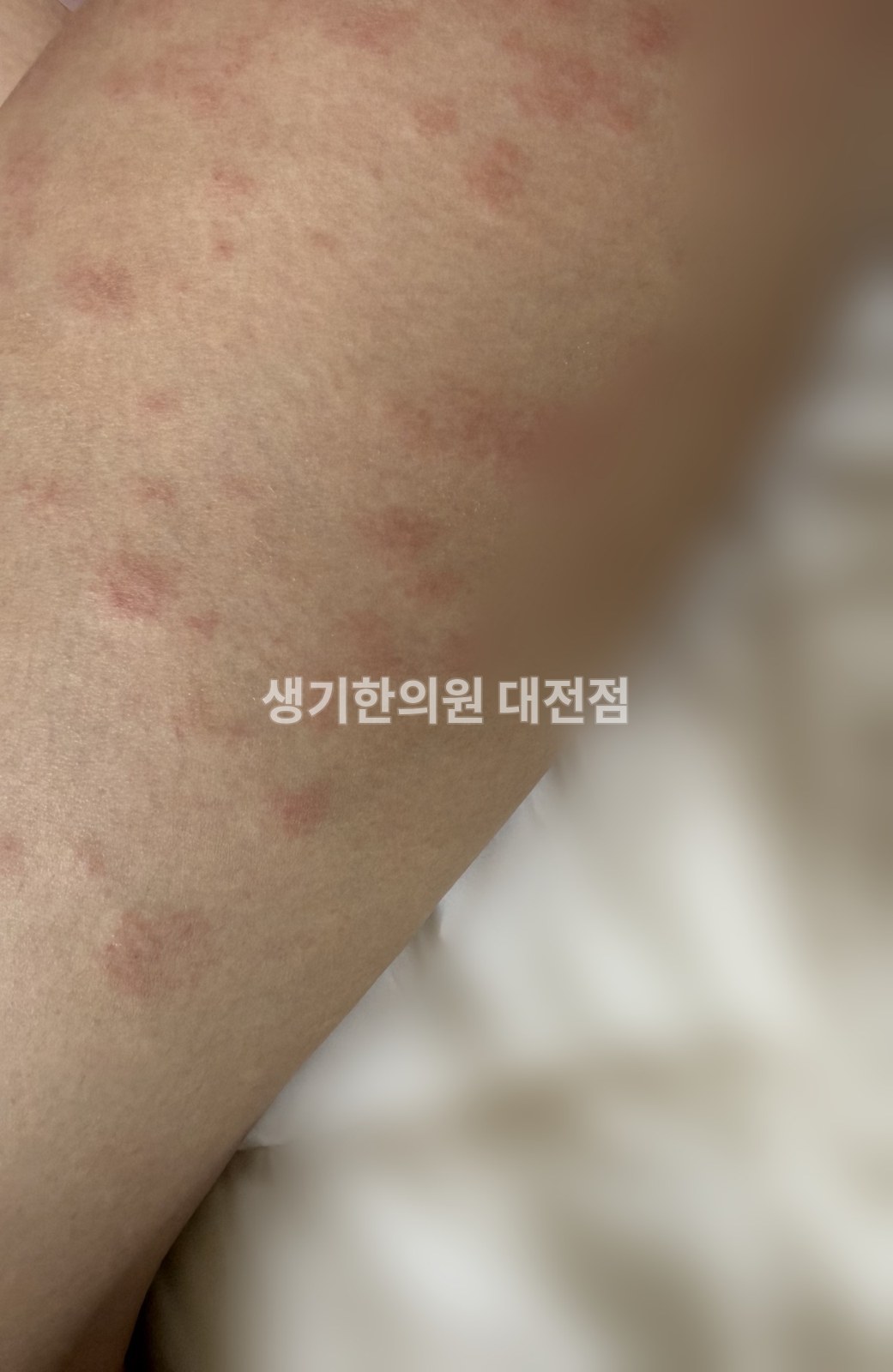 대전 두드러기 증상 사진 · 허벅지에 흩어져 올라온 붉은 팽진 (치료 전, 배경 흐림 처리)