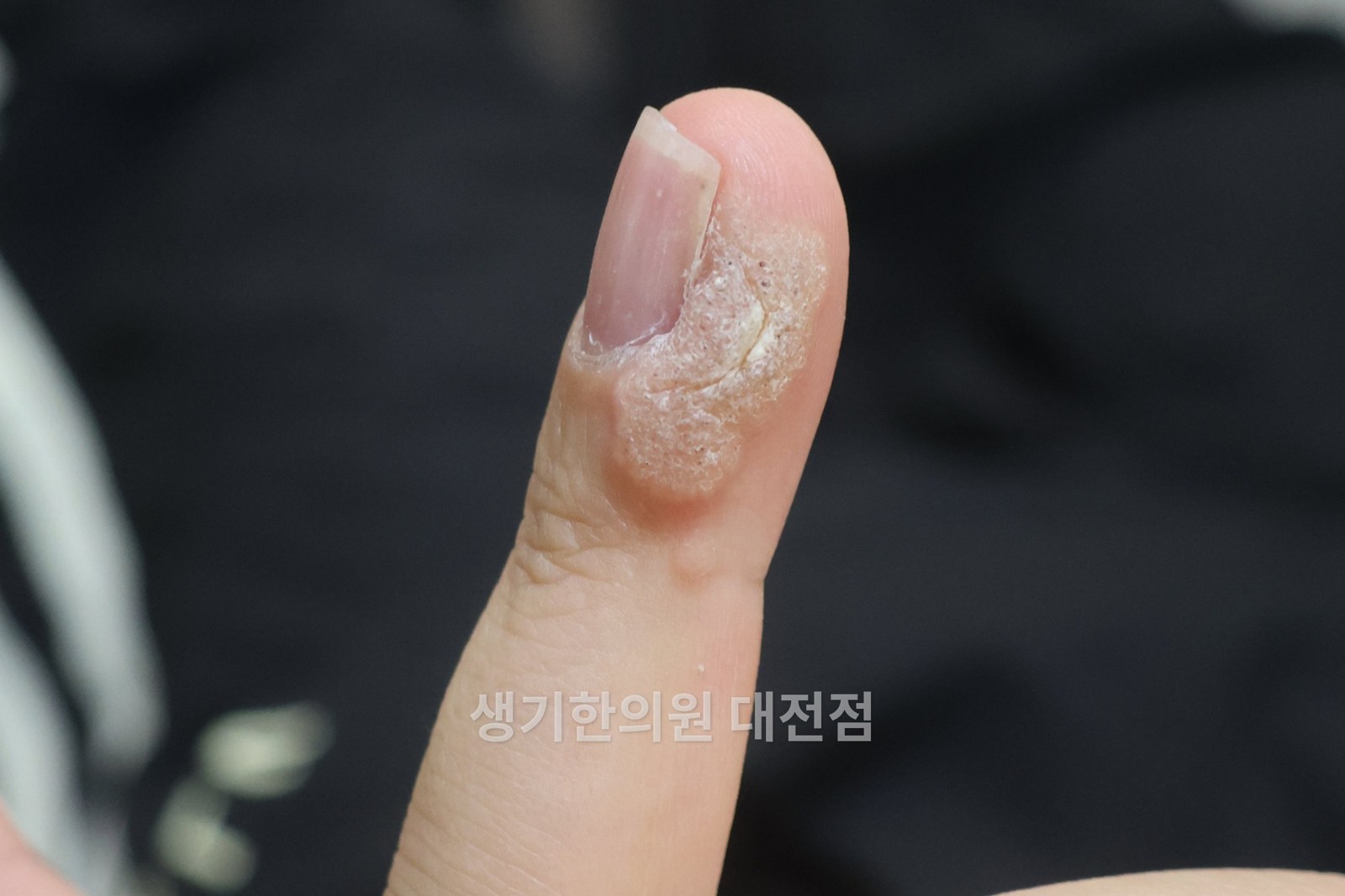 대전 사마귀 증상 사진 · 손가락 끝, 거친 표면과 두꺼워진 각질 (치료 전)