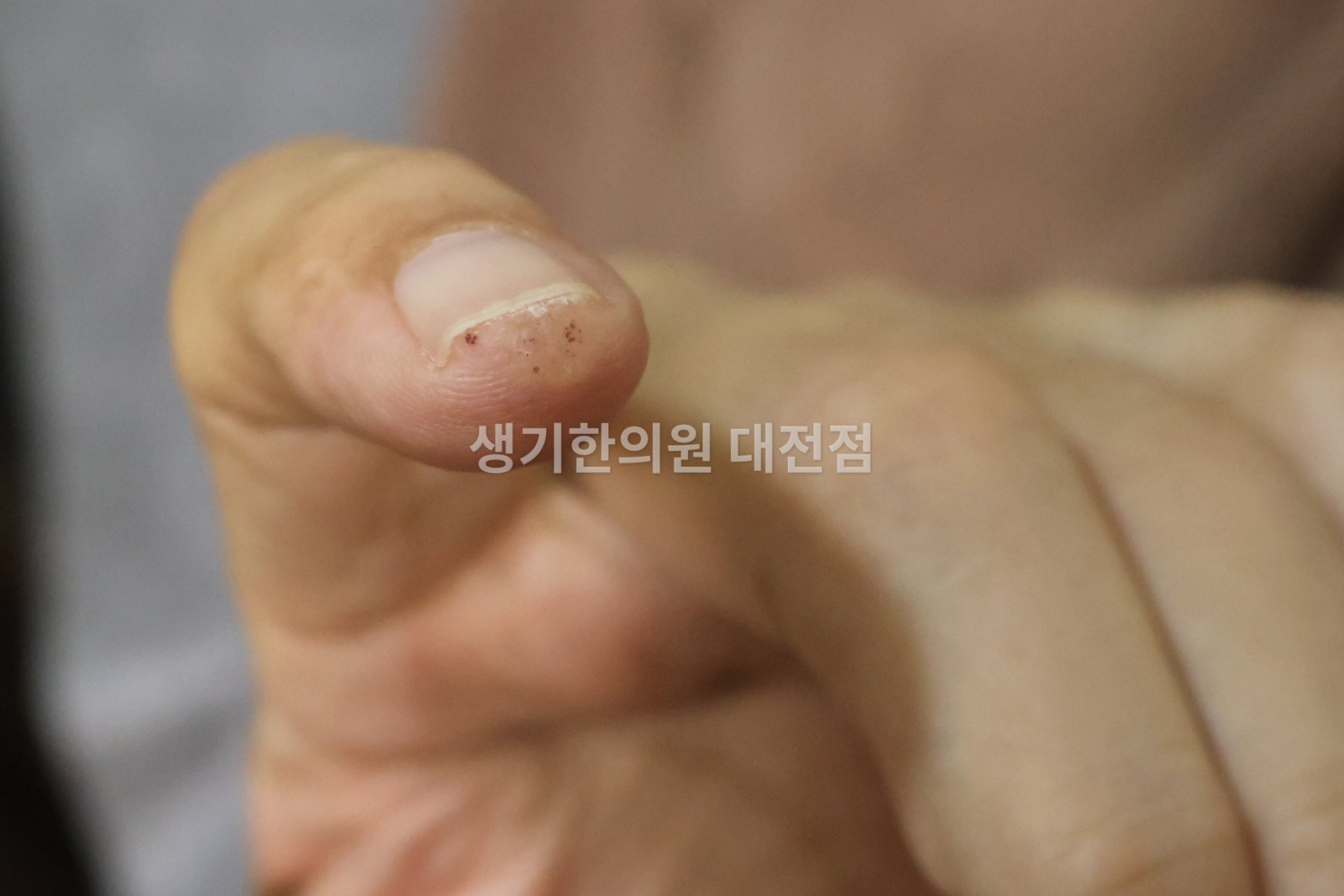 대전 사마귀 증상 사진 · 손톱 가장자리의 작은 검은 점 (치료 전)