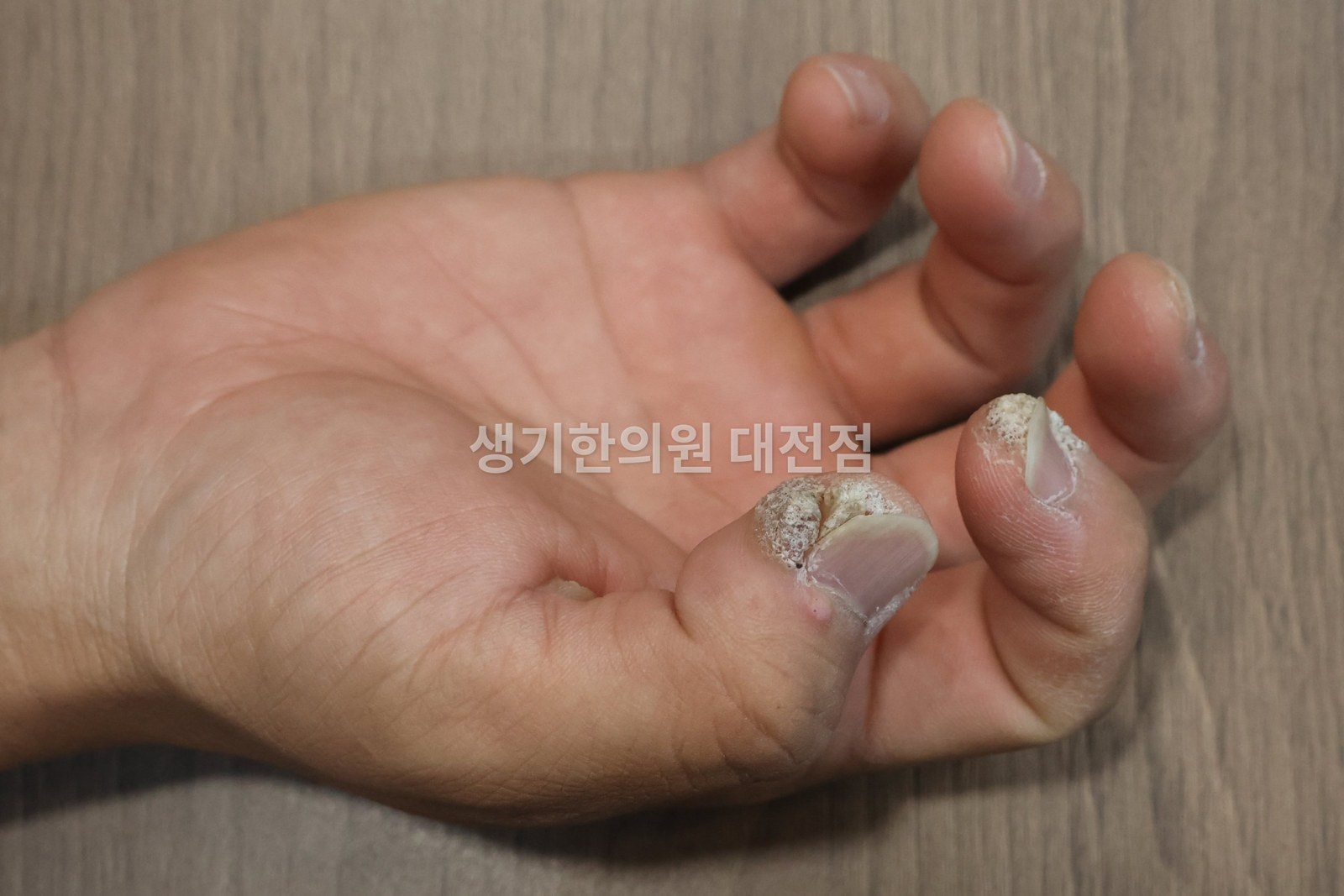대전 사마귀 증상 사진 · 손톱 주위로 두껍게 올라온 병변, 엄지·검지 (치료 전)