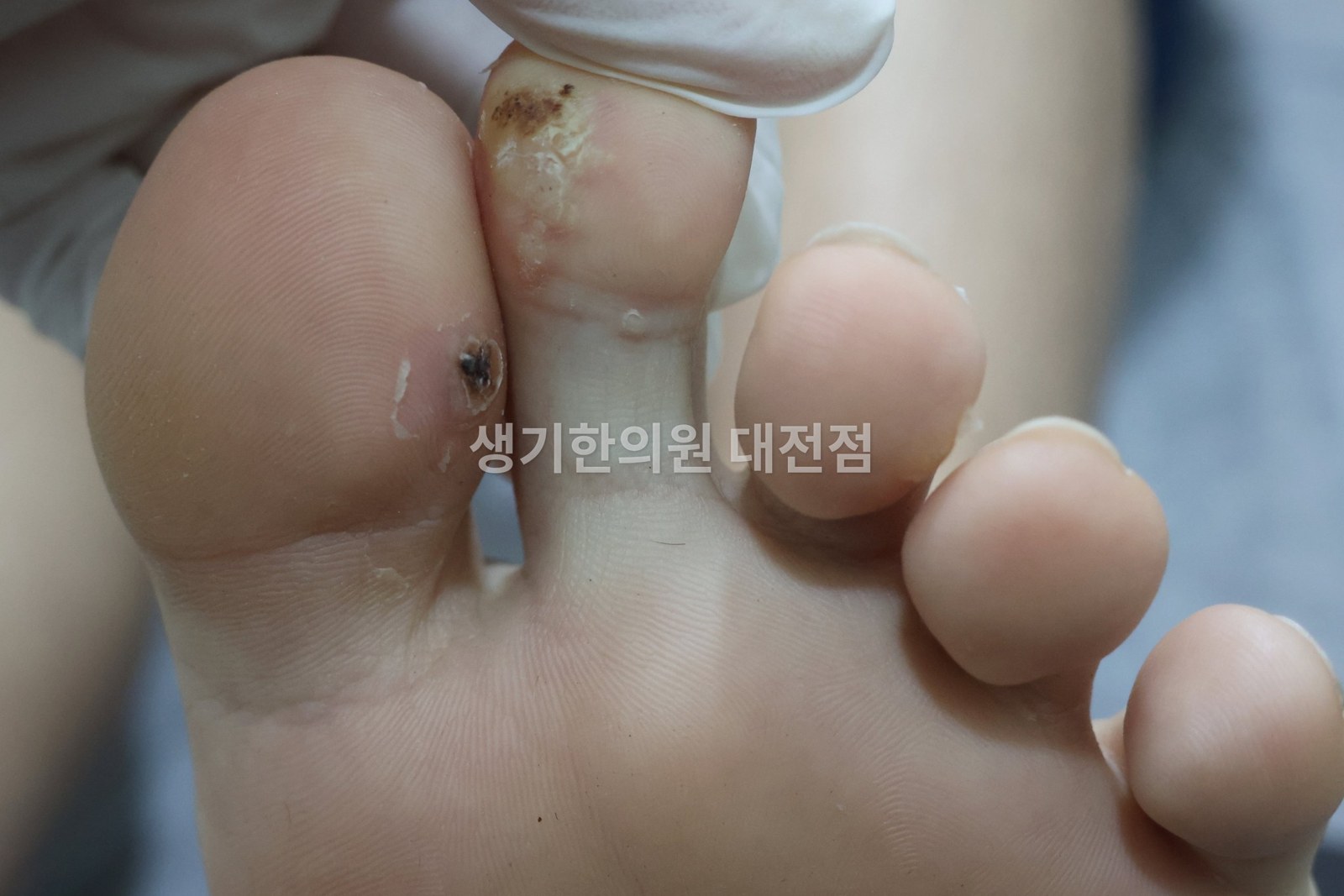 대전 사마귀 증상 사진 · 발가락과 발가락 사이 (치료 전)