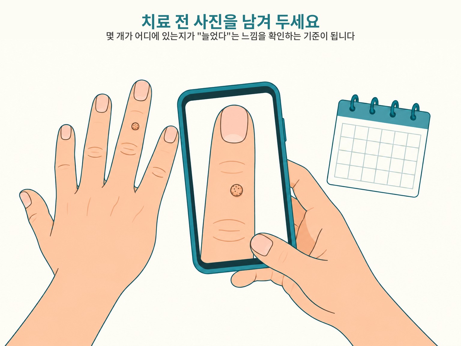 사마귀 치료 전 사진 기록의 중요성을 그린 도해 · 스마트폰으로 손가락 병변을 촬영하는 모습